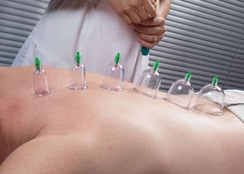 MYOFASCIAL DRY CUPPING FOR SPORT MASSAGE