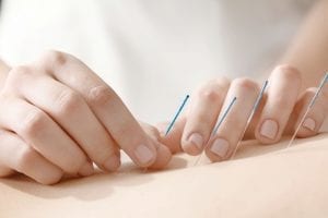 dry needling short course: Young woman undergoing acupuncture treatment, closeup