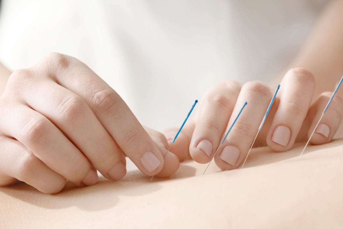 dry needling short course: Young woman undergoing acupuncture treatment, closeup