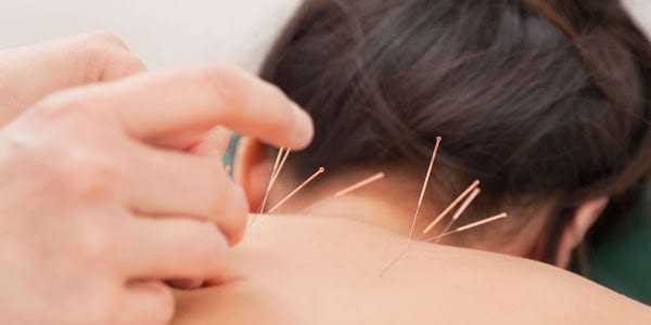 Dry needling. woman receiving dry needling therapy