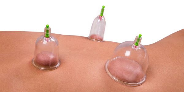 Improving Performance with Dry Cupping and Sports Massage