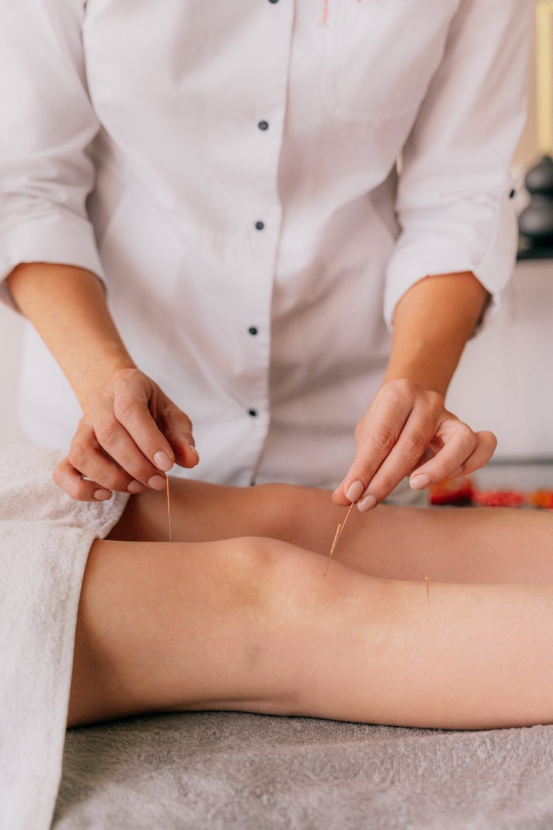 Electroacupuncture dry with needle on female ankle.. Electroacupuncture dry  with needle connecting machine used by acupunturist on female patient for  acupuncture guided by EPI Intratissue Percutaneous Electrolisis. Electro  stimulation in physical therapy