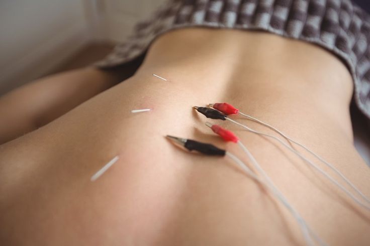 physiotherapist is doing acupuncture