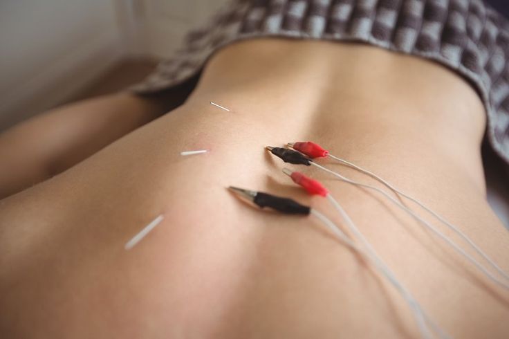 Dry Needling With Electrical Stimulation: A Pain Solution? - CityPT