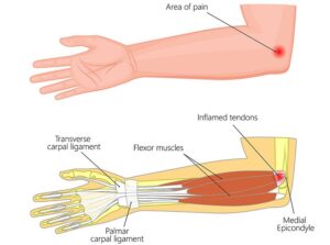 Golfers elbow